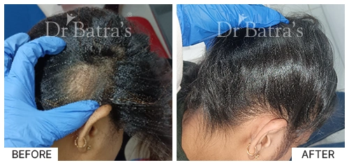 Hair Falling Treatment